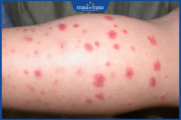 bệnh viêm mao mạch dị ứng