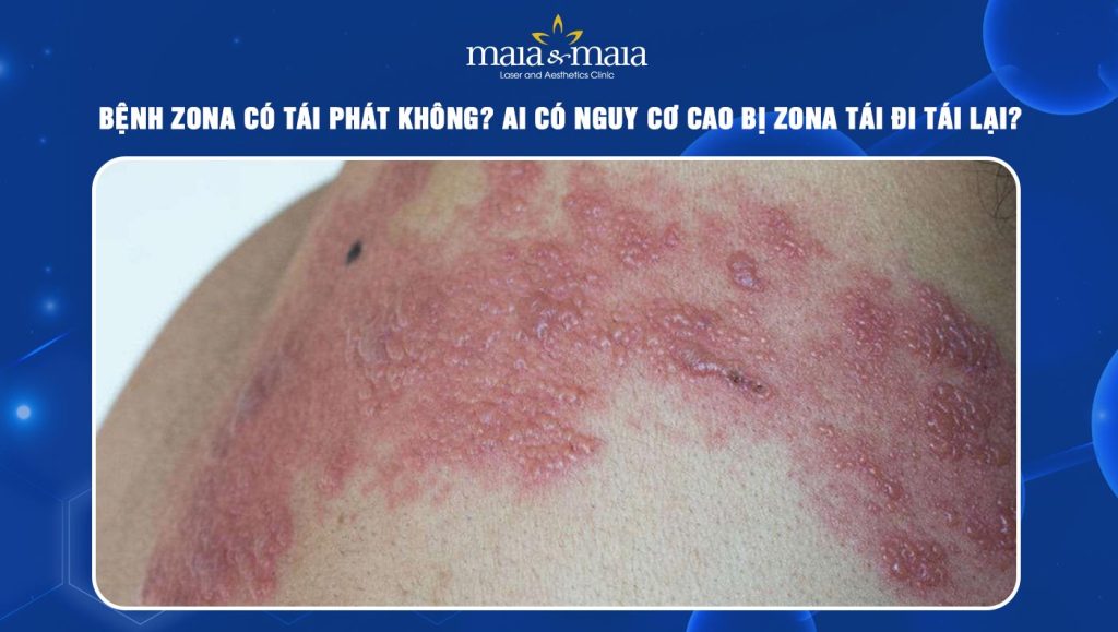 Bệnh zona có tái phát không