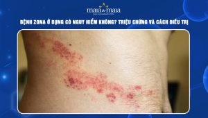 Bệnh zona ở bụng
