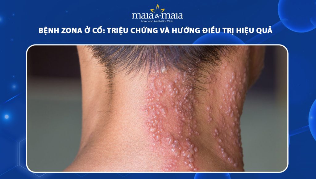 bệnh zona ở cổ