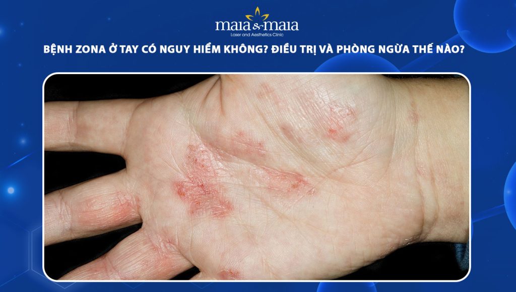 Bệnh zona ở tay có nguy hiểm không? Điều trị và phòng ngừa 1 bệnh zona ở tay