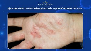 bệnh zona ở tay