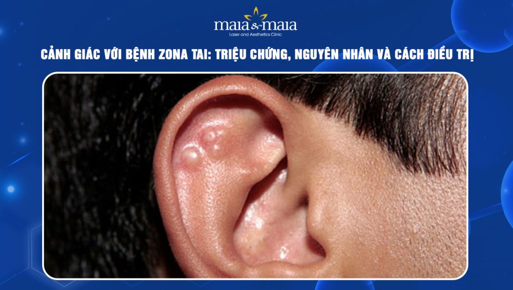 Bệnh zona tai