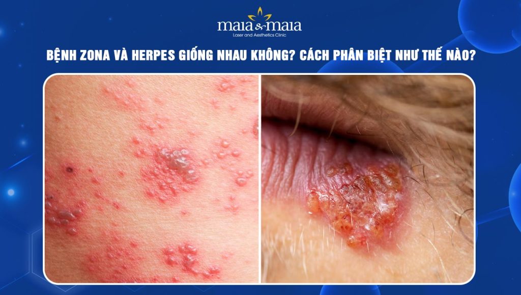 Bệnh zona và herpes giống nhau không? Phân biệt thế nào? 1 bệnh zona và herpes