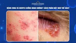 bệnh zona và herpes