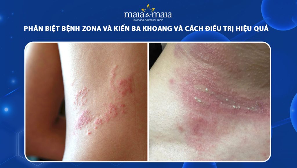 bệnh zona và kiến ba khoang
