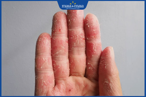 Danh sách các loại dị ứng thường gặp và biện pháp xử lý 3 bị dị ứng với chất tẩy rửa