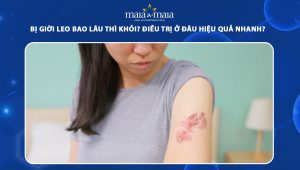 bị giời leo bao lâu thì khỏi