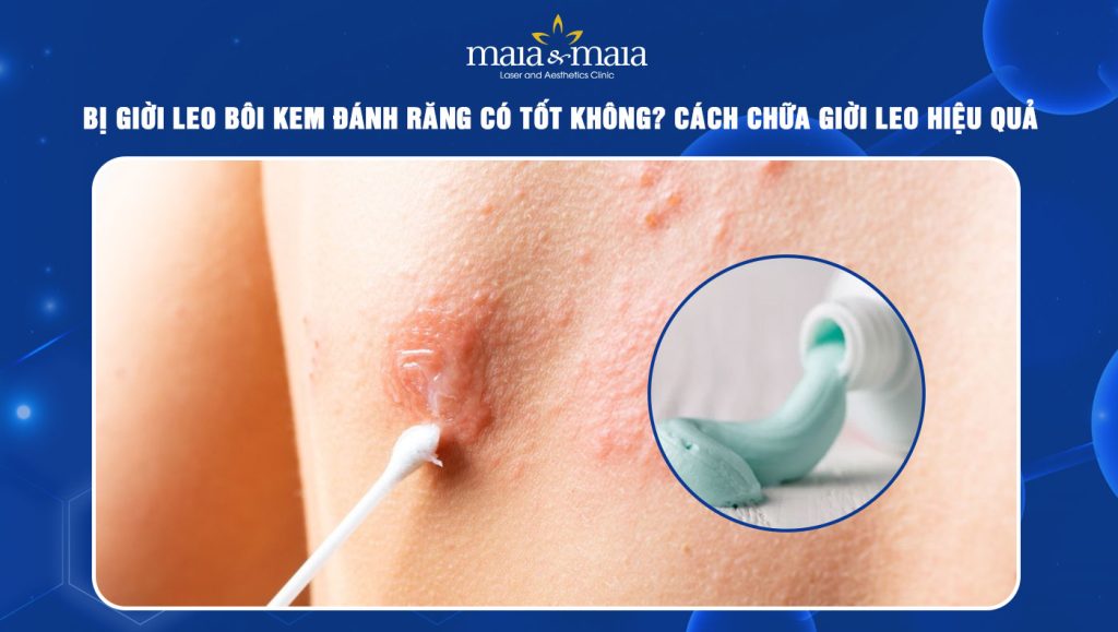 bị giời leo bôi kem đánh răng