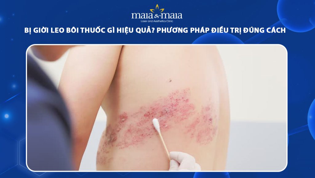 bị giời leo bôi thuốc gì
