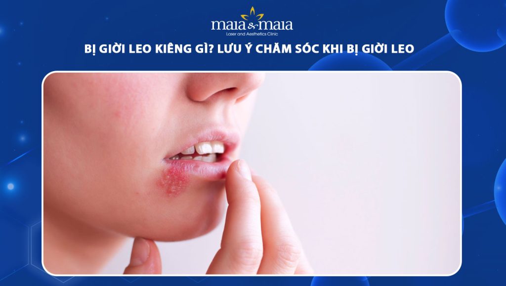 bị giời leo kiêng gì