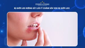 bị giời leo kiêng gì