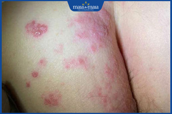 Giời leo ở vùng kín: Dấu hiệu, cách chẩn đoán và điều trị 2 bị giời leo ở vùng kín