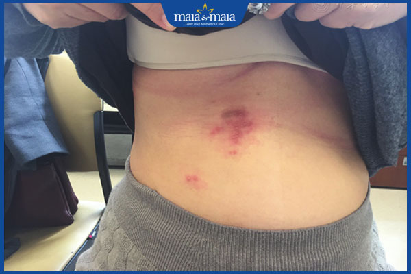 bị giời leo sau sinh