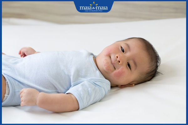 bị zona thần kinh ở trẻ sơ sinh