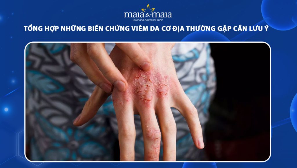 biến chứng viêm da cơ địa