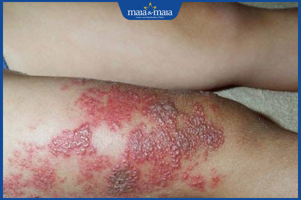 biến chứng zona ở trẻ