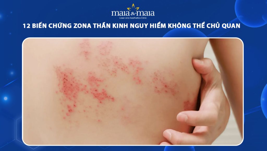 biến chứng zona thần kinh
