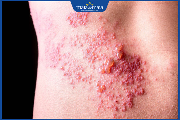 biểu hiện bệnh zona