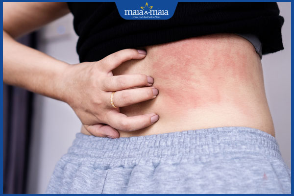 biểu hiện dị ứng ở da