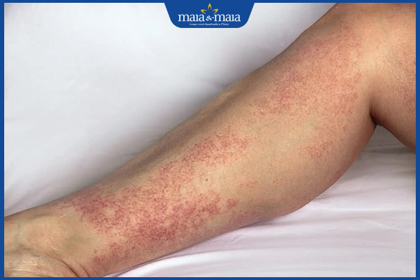 biểu hiện viêm mao mạch dị ứng