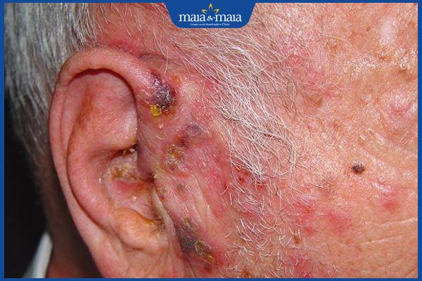 biểu hiện zona tai