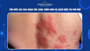 Các giai đoạn của zona thần kinh