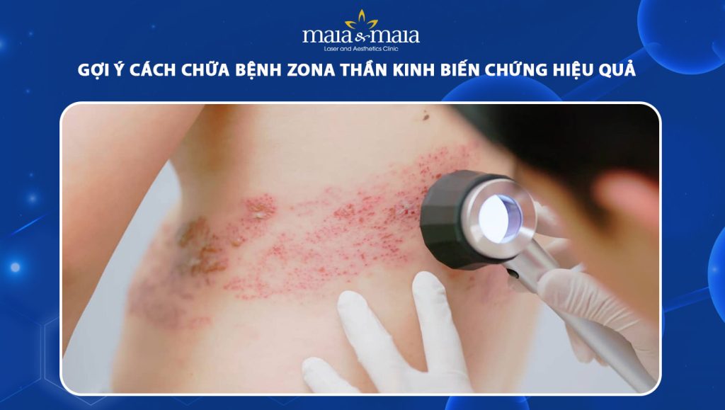 cách chữa bệnh zona thần kinh biến chứng