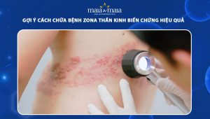 cách chữa bệnh zona thần kinh biến chứng