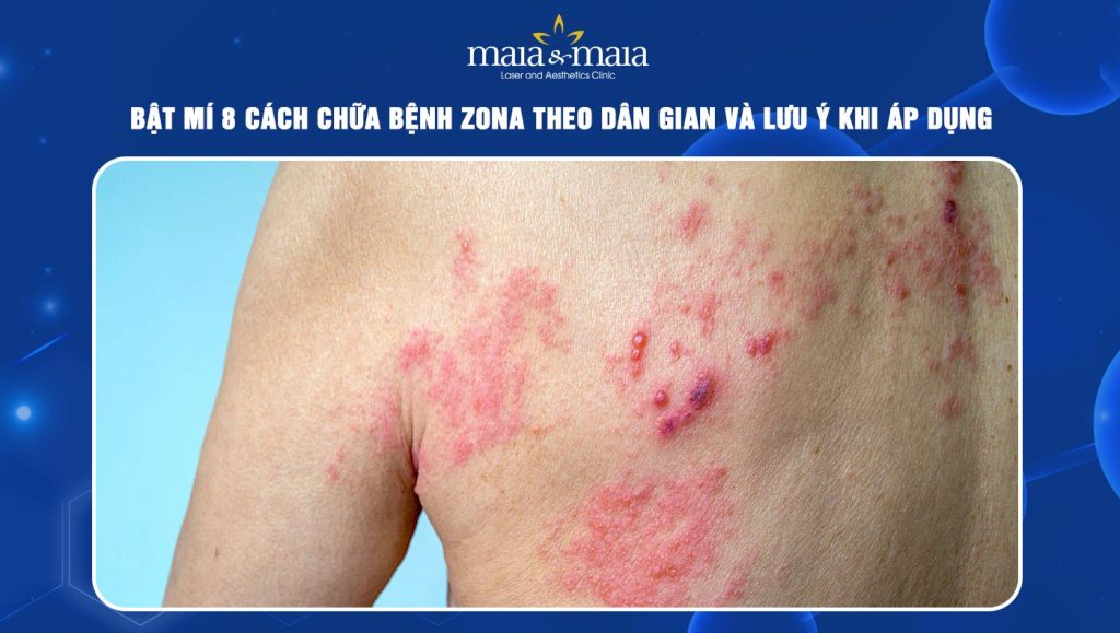 Cách chữa bệnh zona theo dân gian
