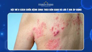 Cách chữa bệnh zona theo dân gian