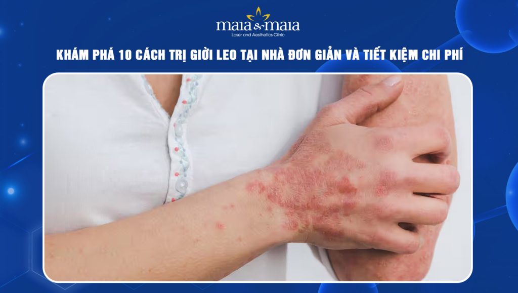 cách trị giời leo tại nhà