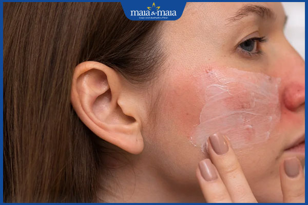 chăm sóc da mặt dị ứng