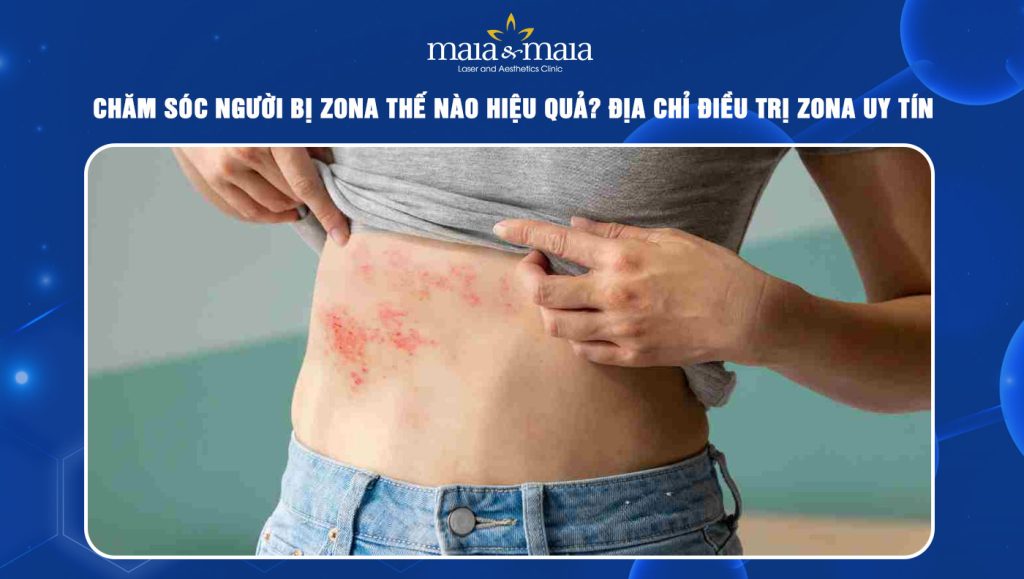 Chăm sóc người bị zona