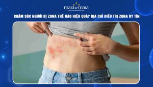 Chăm sóc người bị zona