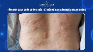 chữa dị ứng thời tiết nổi mề đay