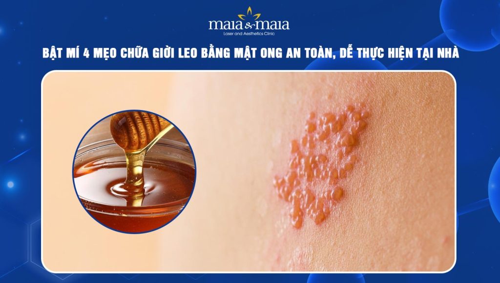 chữa giời leo bằng mật ong