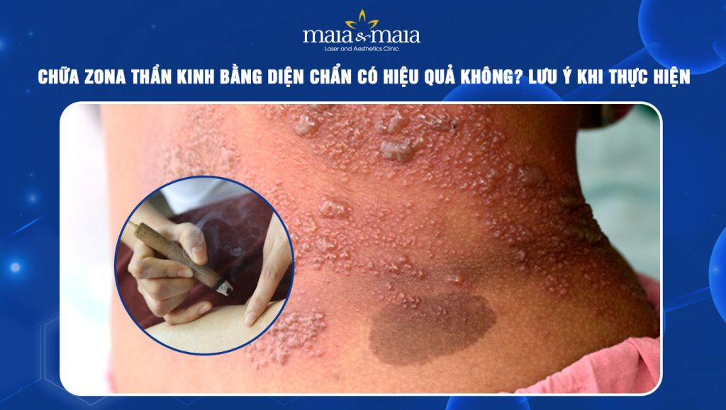 Chữa zona thần kinh bằng diện chẩn