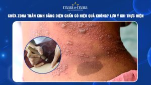 Chữa zona thần kinh bằng diện chẩn