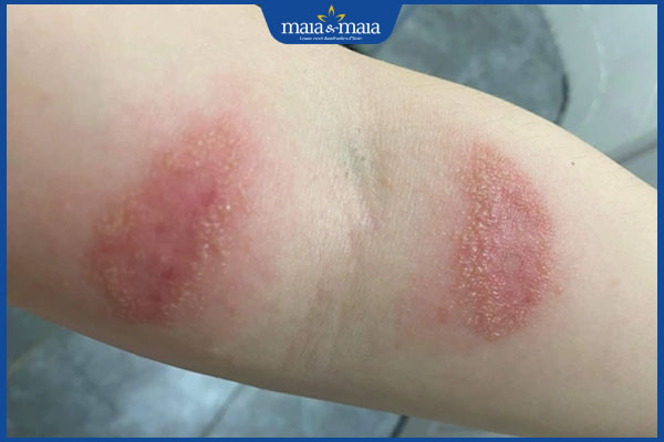 Phân biệt bệnh zona và kiến ba khoang kèm cách điều trị 4 da bỏng rát do kiến ba khoang