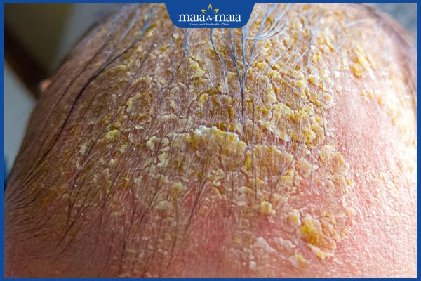 Viêm da tiết bã ở trẻ nhỏ có nguy hiểm không? Cách điều trị 5 da trẻ bong từng mảng