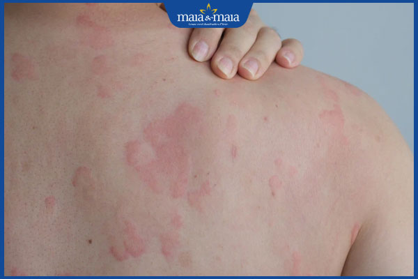 dấu hiệu bị dị ứng