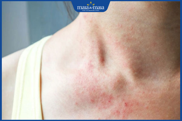 Dị ứng hải sản nguy hiểm không? Triệu chứng và cách điều trị 5 dấu hiệu dị ứng hải sản