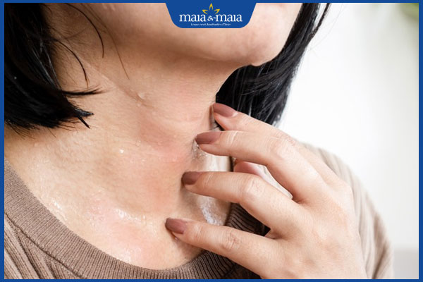 dấu hiệu dị ứng mồ hôi