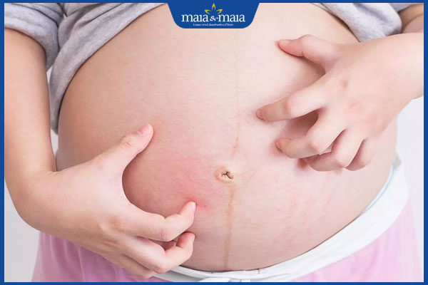 dấu hiệu dị ứng thai kỳ