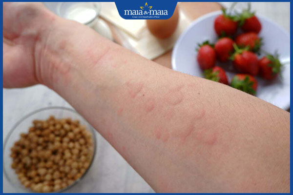 dấu hiệu dị ứng thực phẩm