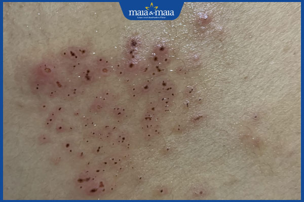 dấu hiệu giời leo đang khỏi