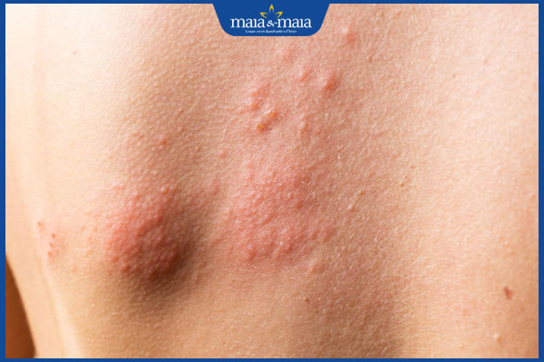 dấu hiệu zona thần kinh ở lưng