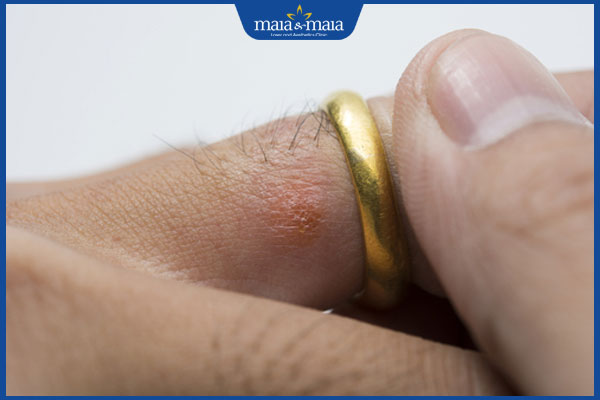 đeo trang sức dị ứng