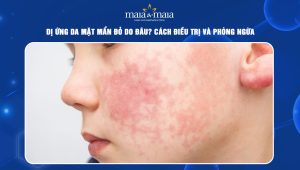 dị ứng da mặt